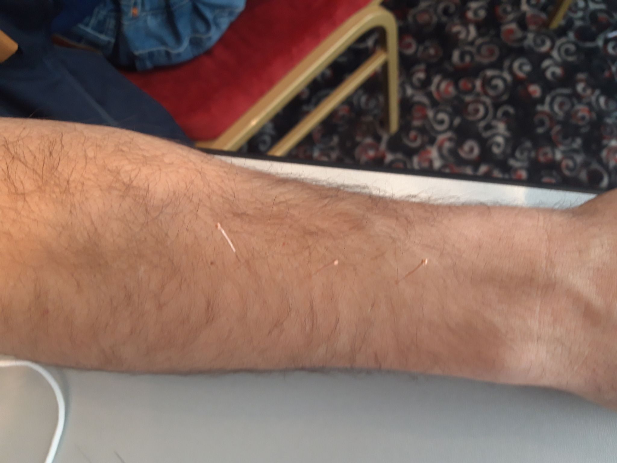 Détail réel d'une séance d'acupuncture au cabinet